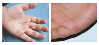 小儿手足口病初期症状_小儿手足口最早期图片