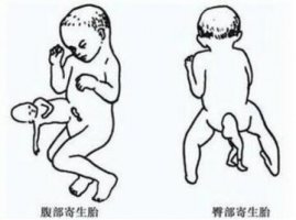 什么是寄生胎？寄生胎能活吗？