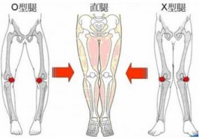 罗圈腿遗传吗？o型腿怎么矫正