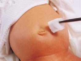 新生儿肚脐出血是怎么回事