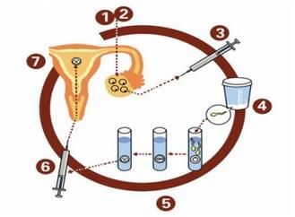 试管婴儿男方取精过程
