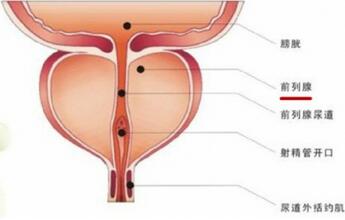 什么是前列腺钙化 怎么治疗