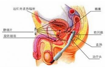 什么是前列腺钙化 怎么治疗