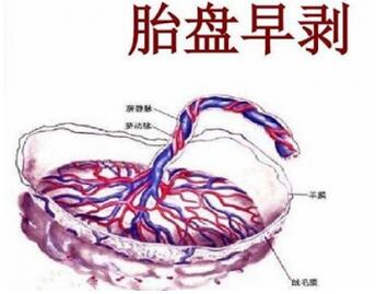 血性羊水的原因有哪些