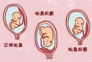 胎盘前置和胎盘前壁的区别