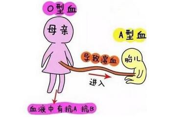 新生儿溶血症发病率是多少