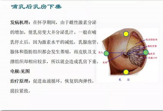 喂奶之后乳房下垂怎么办