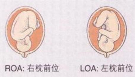 胎位roa和loa各是什么意思