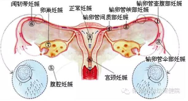 关于“宫外孕”的七个常识