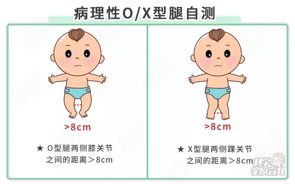 5个习惯最毁腿型，过早扶站、用学步车等