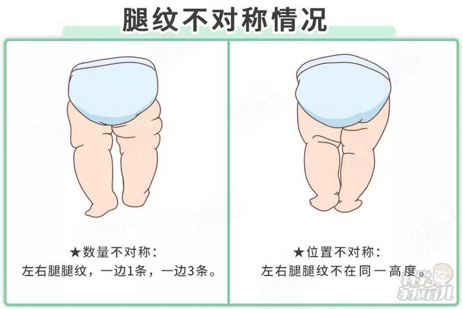 5个习惯最毁腿型，过早扶站、用学步车等