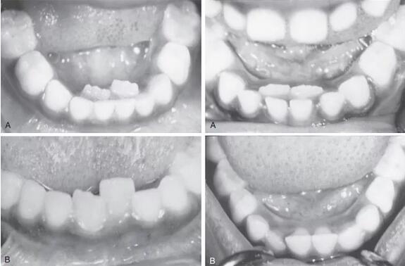 孩子出现双排牙，是否和食物太精细有关？