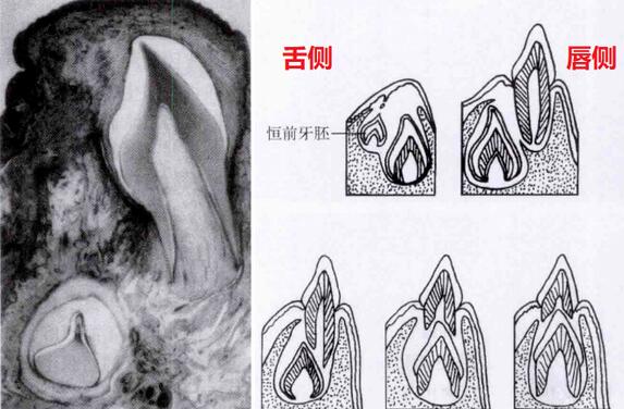 孩子出现双排牙，是否和食物太精细有关？