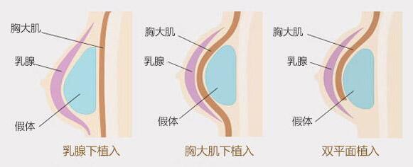 假体隆胸可以喂奶吗