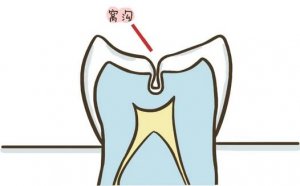 儿童牙齿窝沟封闭有必要做吗？能预防龋齿吗？