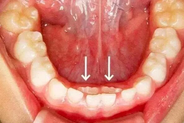 儿童长双排牙怎么办