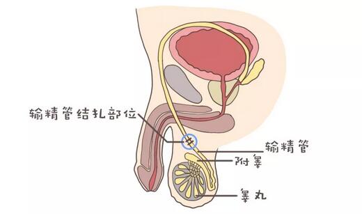 结扎、上环等什么避孕方法最好