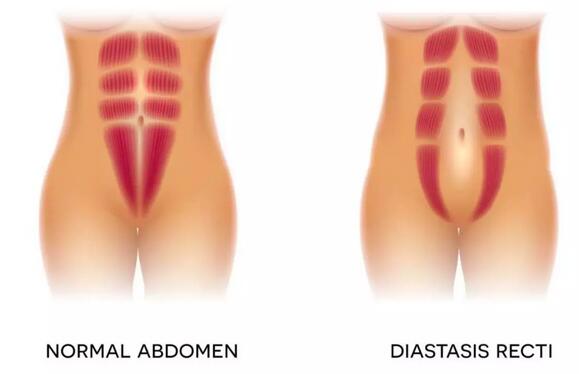 腹直肌分离是怎么回事？该怎么恢复？