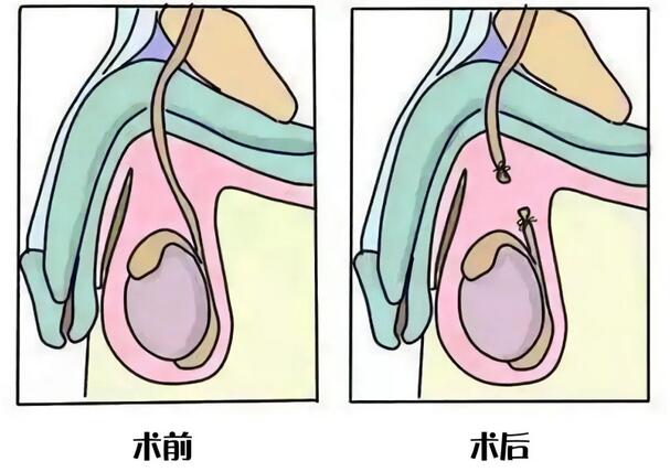 男性结扎后影响啪啪啪吗？精子都去哪了？