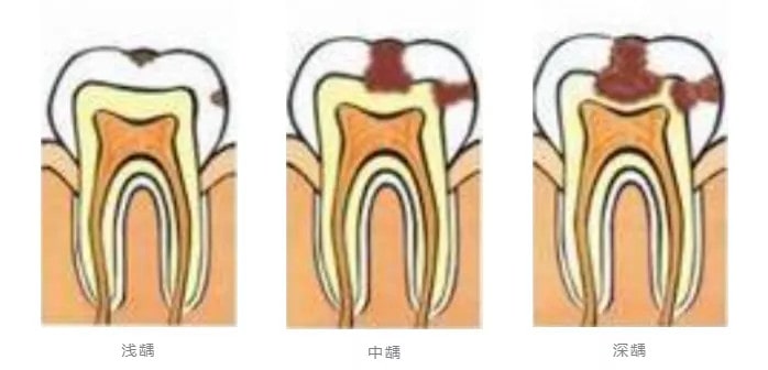 婴儿乳牙龋齿要不要管？