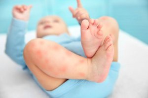怎么判断宝宝是过敏还是长湿疹？