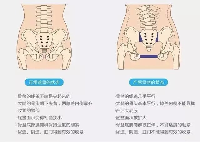 每位产妇都要做骨盆修复吗？