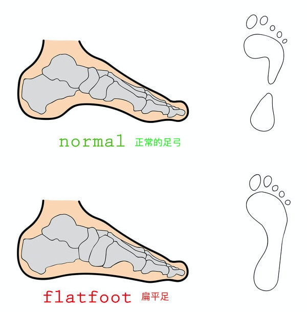 扁平足怎么判断