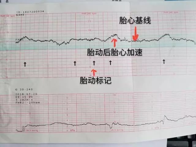 孕期必做的5次产检项目