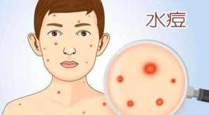 水痘的护理和预防