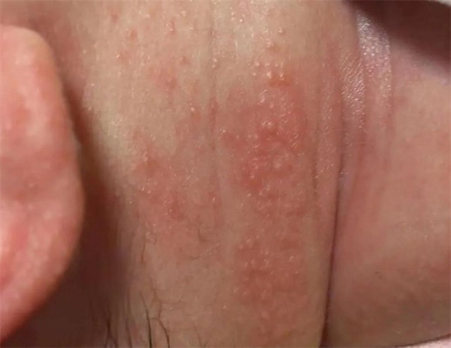 湿疹和热疹的区别图片