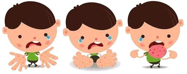 疱疹性咽颊炎和手足口病的区别