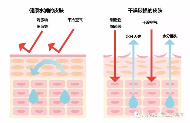 痱子和湿疹的区别