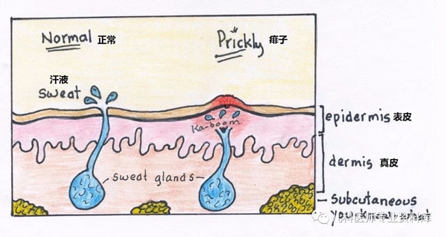 痱子和湿疹的区别