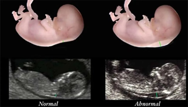孕前3个月b超单怎么看，2个数据知道胎儿发育的小秘密