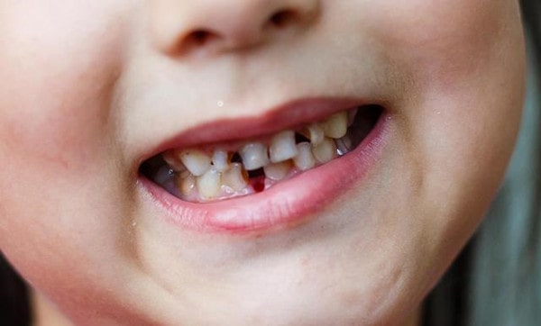 小孩牙齿早期干预什么时候合适